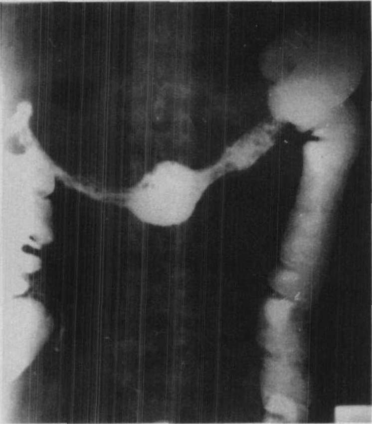 2.潰瘍性結(jié)腸炎